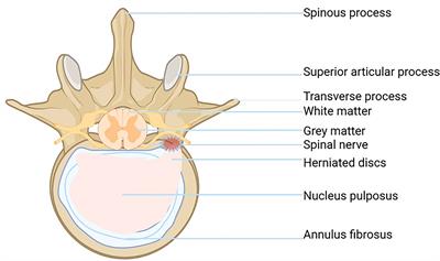 The role of oxidative stress in intervertebral disc cellular senescence